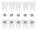 Orthodontic set of jaws with teeth with braces vector illustration